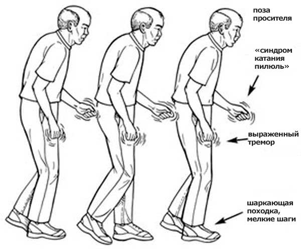 симптомы болезни паркинсона