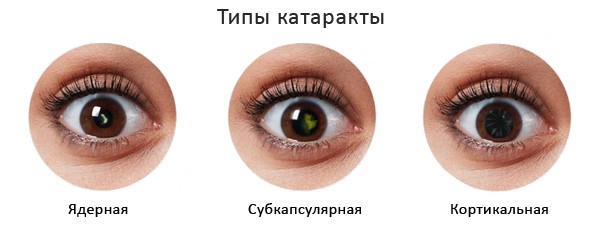 виды катаракты