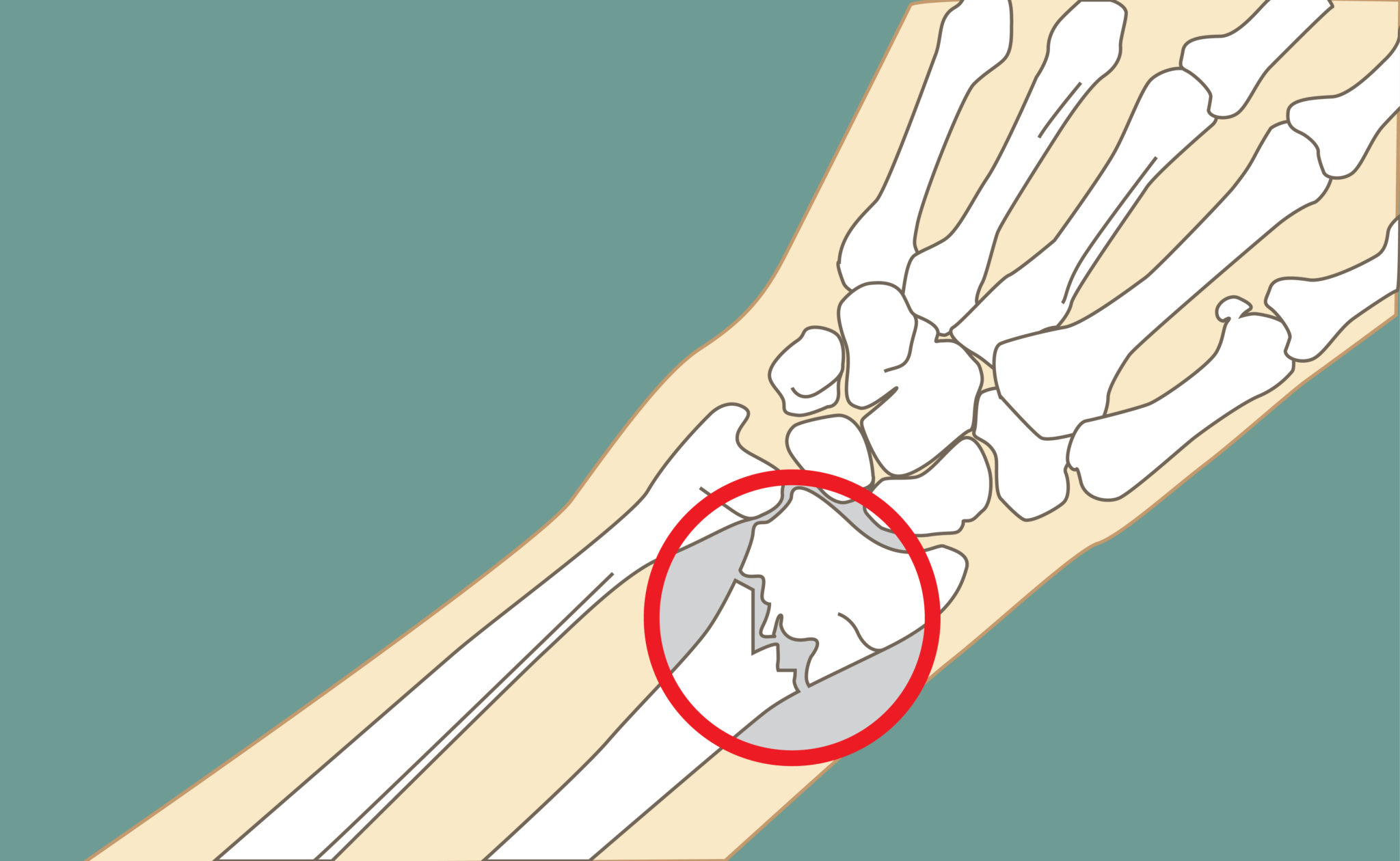 перелом кисти руки