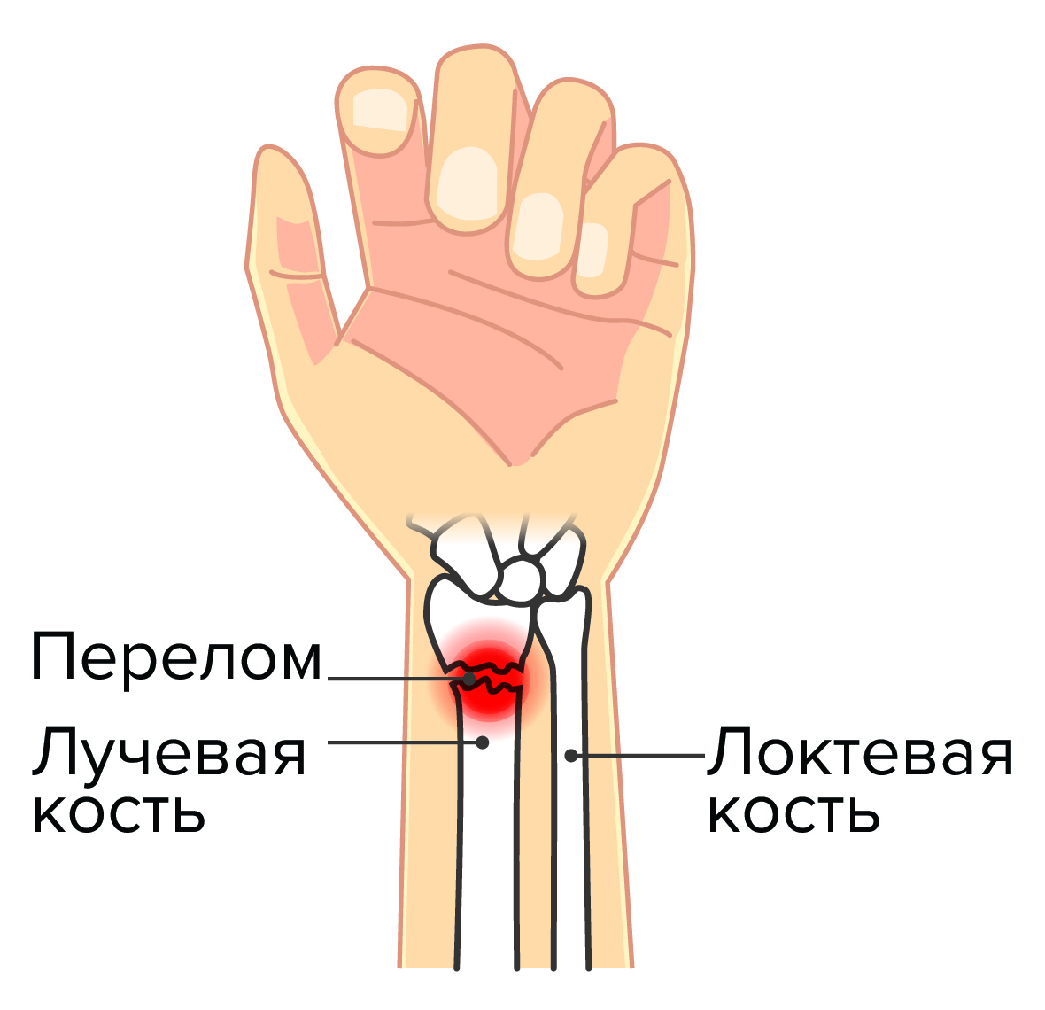 перелом лучевой кости