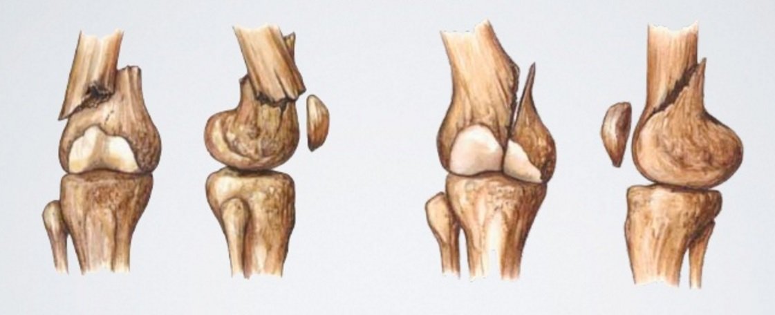 перелом мыщелка