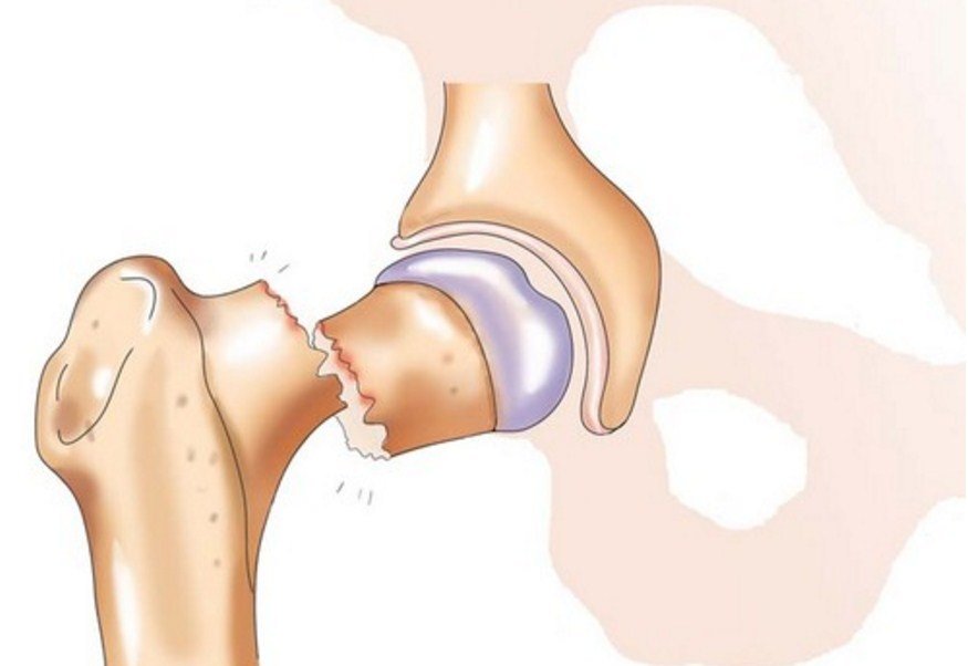 перелом шейки бедра